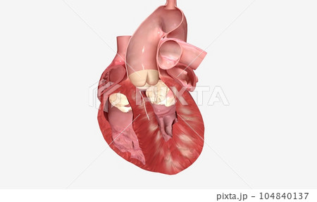 Removes excess heart muscle tissue, improves blood flow Removes excess heart muscle tissue, improves blood flow 104840137
