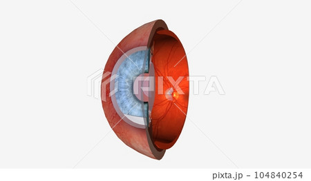 Uveitis is swelling and irritation of the uvea, the middle layer Uveitis is swelling and irritation of the uvea, the middle layer 104840254