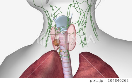In stage III thyroid cancer, the tumor may be larger than 4 cm a 104840262