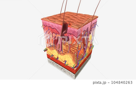 Pyoderma Gangrenosum Stage I 3d 104840263