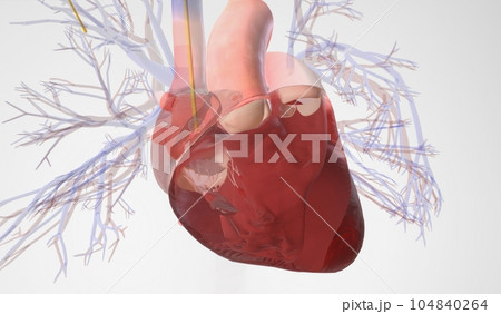 Pulmonary Artery Catheter Insertion into the Right Ventricle Pulmonary Artery Catheter Insertion into the Right Ventricle 104840264