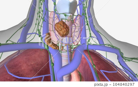 In stage IV thyroid cancer, the tumor has grown beyond the thyro In stage IV thyroid cancer, the tumor has grown beyond the thyro 104840297