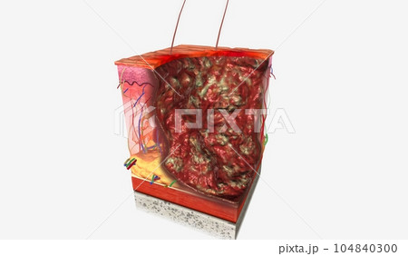 Pyoderma Gangrenosum Stage III3d Pyoderma Gangrenosum Stage III3d 104840300