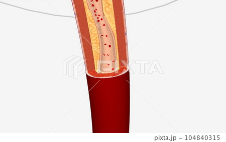 Narrowed Blood Vessel in Lower Extremity Narrowed Blood Vessel in Lower Extremity 104840315