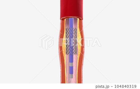 The balloon expends, widening the wire mesh stent and the artery 104840319