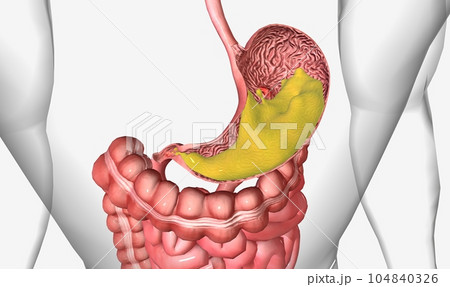 Peptic ulcer disease, is the formation of ulcers in the lining of the stomach and first section of the small intestine 104840326