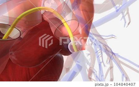 The Pulmonary Artery Catheter (PAC) 104840407