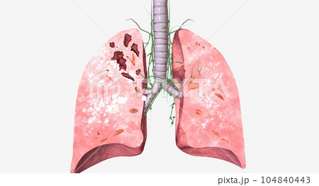 The Tuberculosis EarlyIntermediate in Lungs The Tuberculosis EarlyIntermediate in Lungs 104840443