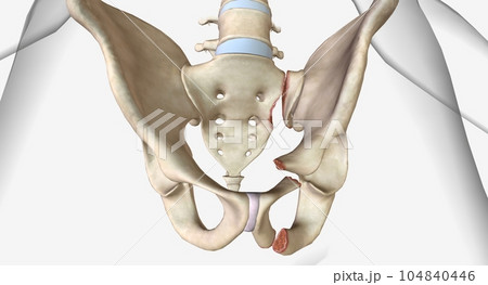 Unstable pelvic fractures usually include more than two breaks t Unstable pelvic fractures usually include more than two breaks t 104840446