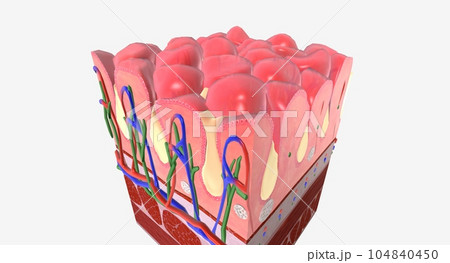 Ulcerative Colitis, Effects on Colon Tissue Ulcerative Colitis, Effects on Colon Tissue 104840450