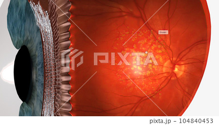 Dry macular degeneration is a type of age-related vision impairment that results in blurred or lost central vision. 104840453