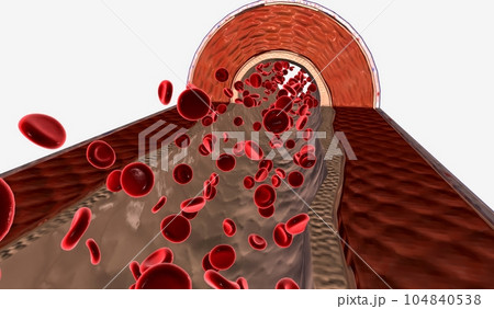 Pulmonary hypertension happens when the pressure in the blood vessels leading from the heart to the lungs is too high. 104840538