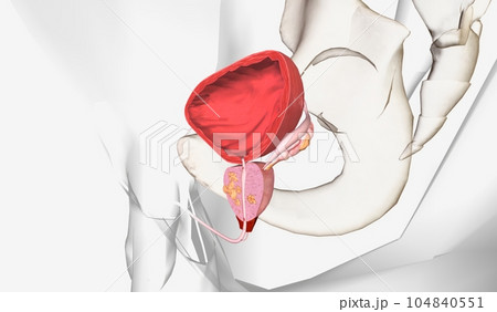 The Stage III Prostate Cancer The Stage III Prostate Cancer 104840551