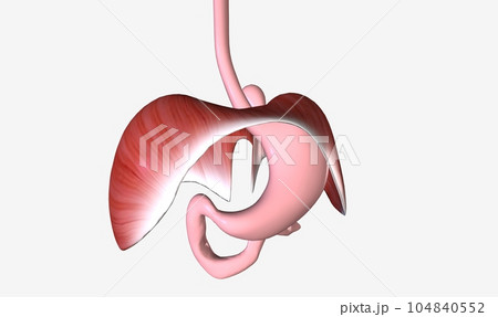 A hiatal hernia is a condition in which the upper part of the stomach bulges through an opening in the diaphragm A hiatal hernia is a condition in which the upper part of the stomach bulges through an opening in the diaphragm 104840552