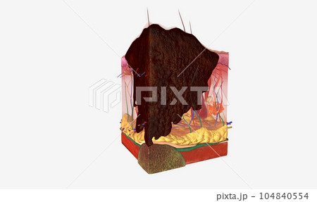 The Stage IV melanoma tumors 104840554