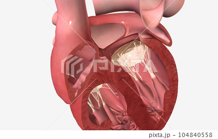 Patent foramen ovale (PFO) is an abnormal hole present in the wall between the two upper chambers of the heart, or atria. PFO is a congenital condition, meaning it is present at birth Patent foramen ovale (PFO) is an abnormal hole present in the wall between the two upper chambers of the heart, or atria. PFO is a congenital condition, meaning it is present at birth 104840558