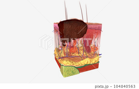 Stage I melanoma tumors have spread out of the epidermis and into the dermis Stage I melanoma tumors have spread out of the epidermis and into the dermis 104840563