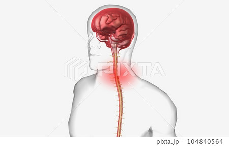 Meningitis is the inflammation of the meninges 104840564