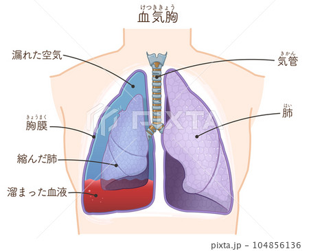 肺・気管・気胸・血胸・血気胸のイラスト 104856136