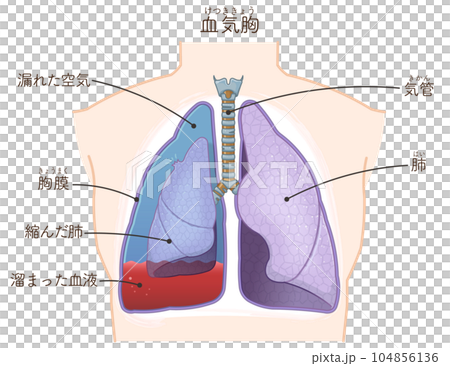 Illustration of lungs, trachea, pneumothorax, hemothorax, hemopneumothorax 104856136