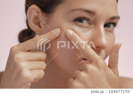 Skin Problem. Depressed Woman Touching Pimple On Her Face 104877250