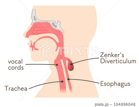 ゼンカー憩室・Zenker's Diverticulum・illustration ゼンカー憩室・Zenker's Diverticulum・illustration 104896048