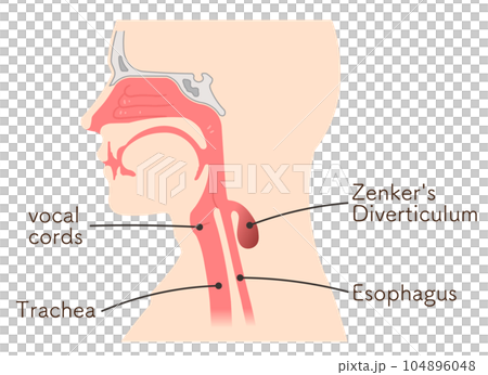 ゼンカー憩室・Zenker's Diverticulum・illustration ゼンカー憩室・Zenker's Diverticulum・illustration 104896048