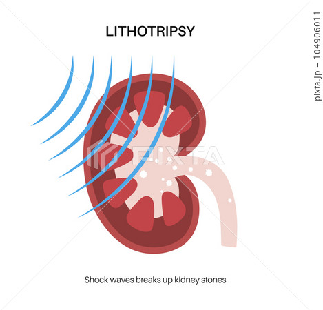 Lithotripsy procedure concept Lithotripsy procedure concept 104906011