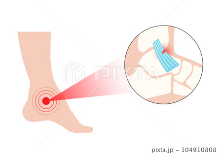 Sprained ankle injury 104910808