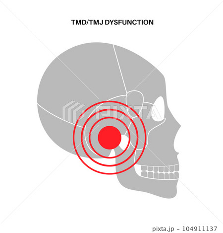 TMD TMJ disorder TMD TMJ disorder 104911137