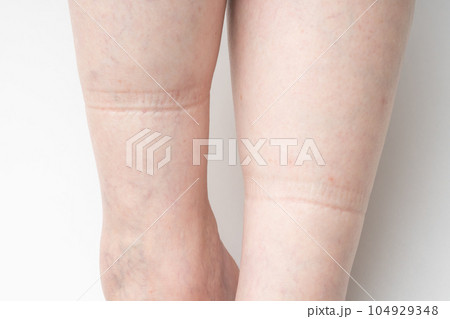 足のむくみ　ゴム跡 104929348
