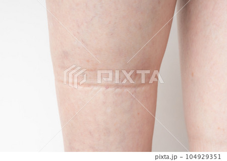 足のむくみ　ゴム跡 104929351