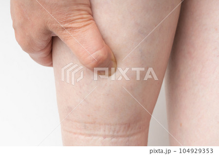 足のむくみ ゴム跡 足のむくみ ゴム跡 104929353