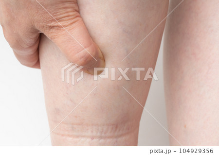 足のむくみ　ゴム跡 104929356