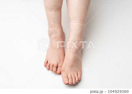 足のむくみ ゴム跡 足のむくみ ゴム跡 104929360