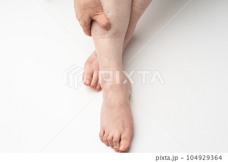 足のむくみ　ゴム跡 104929364