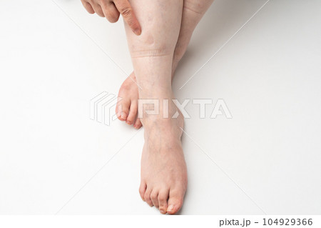 足のむくみ　ゴム跡 104929366