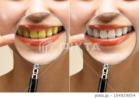 ホワイトニング 104929854