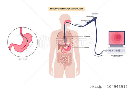 Endoscopic sleeve gastroplasty Endoscopic sleeve gastroplasty 104948913