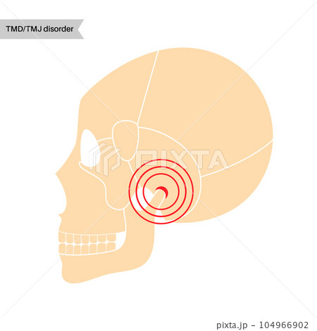 TMD TMJ disorder TMD TMJ disorder 104966902