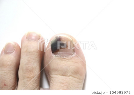 内出血　左足の親指の爪 104995973
