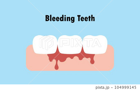 Bleeding White teeth while cleaning because brushing with toothbrush illustration cartoon character vector design on blue background. Dental care concept Bleeding White teeth while cleaning because brushing with toothbrush illustration cartoon character vector design on blue background. Dental care concept 104999145