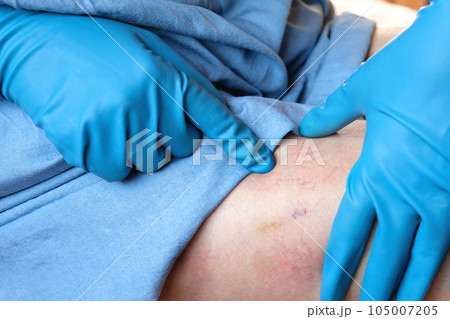 Phlebologist examines a patient with varicose veins on his leg. Leg pain. Phlebology. Venous pathologies of the lower extremities. Human vessel, arteries. Capillaries. Blood system. Health legs Phlebologist examines a patient with varicose veins on his leg. Leg pain. Phlebology. Venous pathologies of the lower extremities. Human vessel, arteries. Capillaries. Blood system. Health legs 105007205