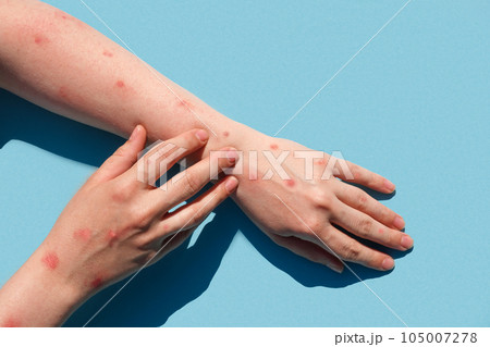 Monkeypox new disease dangerous over the world. Patient with Monkey Pox. Painful rash, red spots blisters on the hand. Close up rash, human hands with Health problem. Banner, copy space 105007278