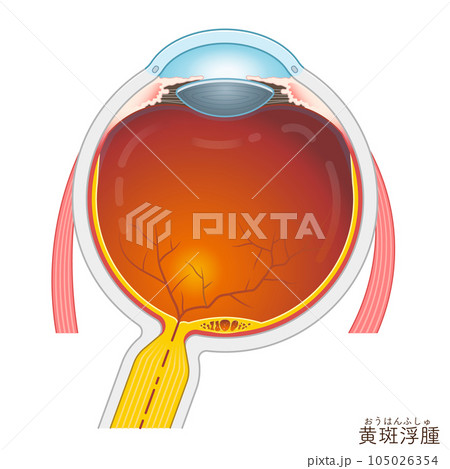 眼球・黄斑浮腫・macular edema・イラスト・eye・illustration 105026354