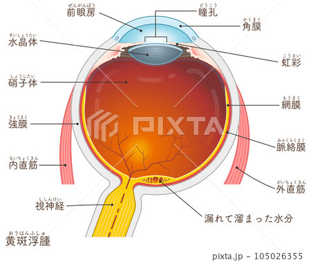 眼球・黄斑浮腫・macular edema・イラスト・eye・illustration 眼球・黄斑浮腫・macular edema・イラスト・eye・illustration 105026355