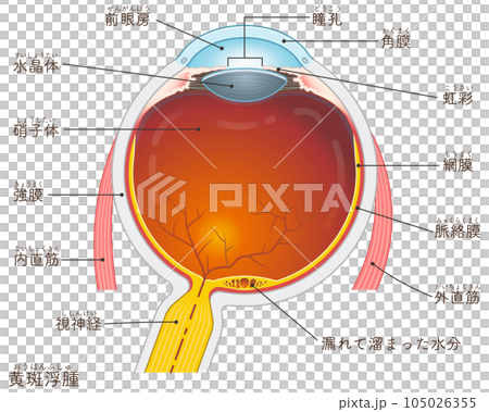 眼球・黄斑浮腫・macular edema・イラスト・eye・illustration 眼球・黄斑浮腫・macular edema・イラスト・eye・illustration 105026355