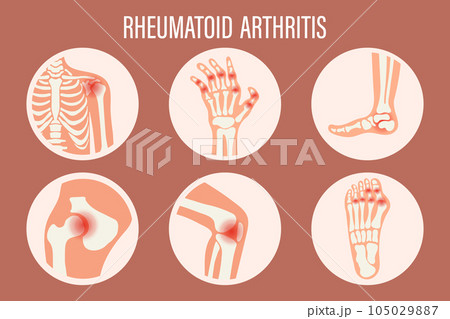 Rheumatoid arthritis icons. Knee joint, shoulder joint, wrist joint, hip joint, foot joint. Types of arthritis. Medical concept. Vector 105029887