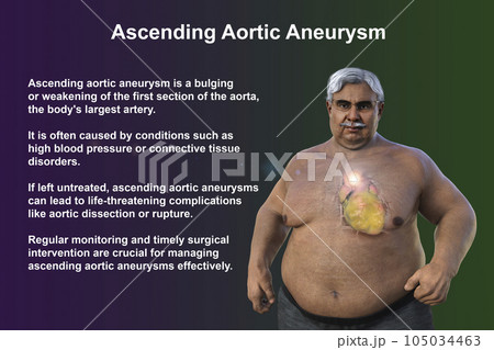 A 3D scientific illustration of a senior obese man with transparent skin revealing an ascending aortic aneurysm. 105034463