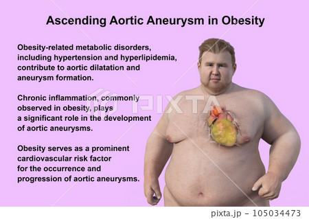 A 3D scientific illustration of an obese man with transparent skin revealing an ascending aortic aneurysm. 105034473